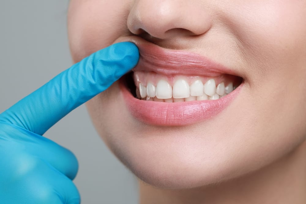 Healthy Gum Line Check During Dental Visit – Gum Disease Treatment Close-up of a smiling patient’s upper gums being examined by a dentist wearing blue gloves – Gum Disease Treatment