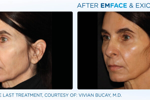 Emface_Exion_PIC_BA-card-face-female-102_ENUS100