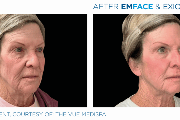 Emface_Exion_PIC_Ba-card-face-female-013_ENUS100