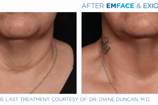 Emface_Exion_PIC_Ba-card-neck-female-003_FRF_Face_ENUS100 (1)