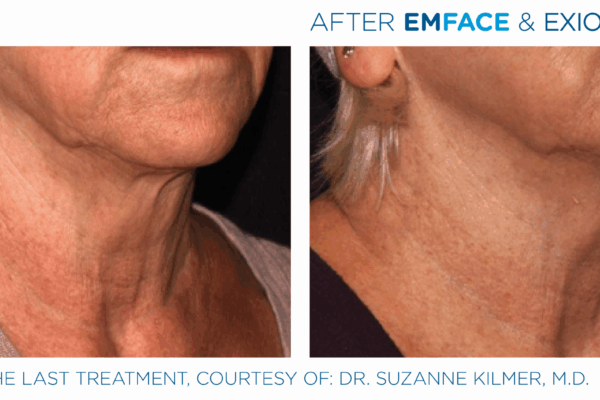 Emface_Exion_PIC_Ba-card-neck-female-006_FRF_Face_ENUS100