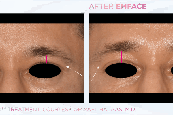 Emface_PIC_Ba-card-male-eyebrows-033_ENUS100