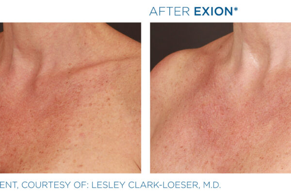 Exion_PIC_Ba-card-chest-female-111_Clear-RF_ENUS100