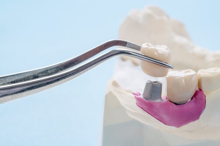 Dental implants | Palencia Dental Care