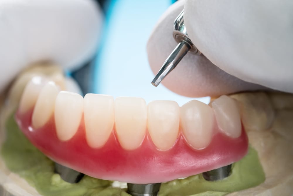 Close-up of a dental technician using a handpiece tool on a model of prosthetic teeth with implants – Dental Crowns