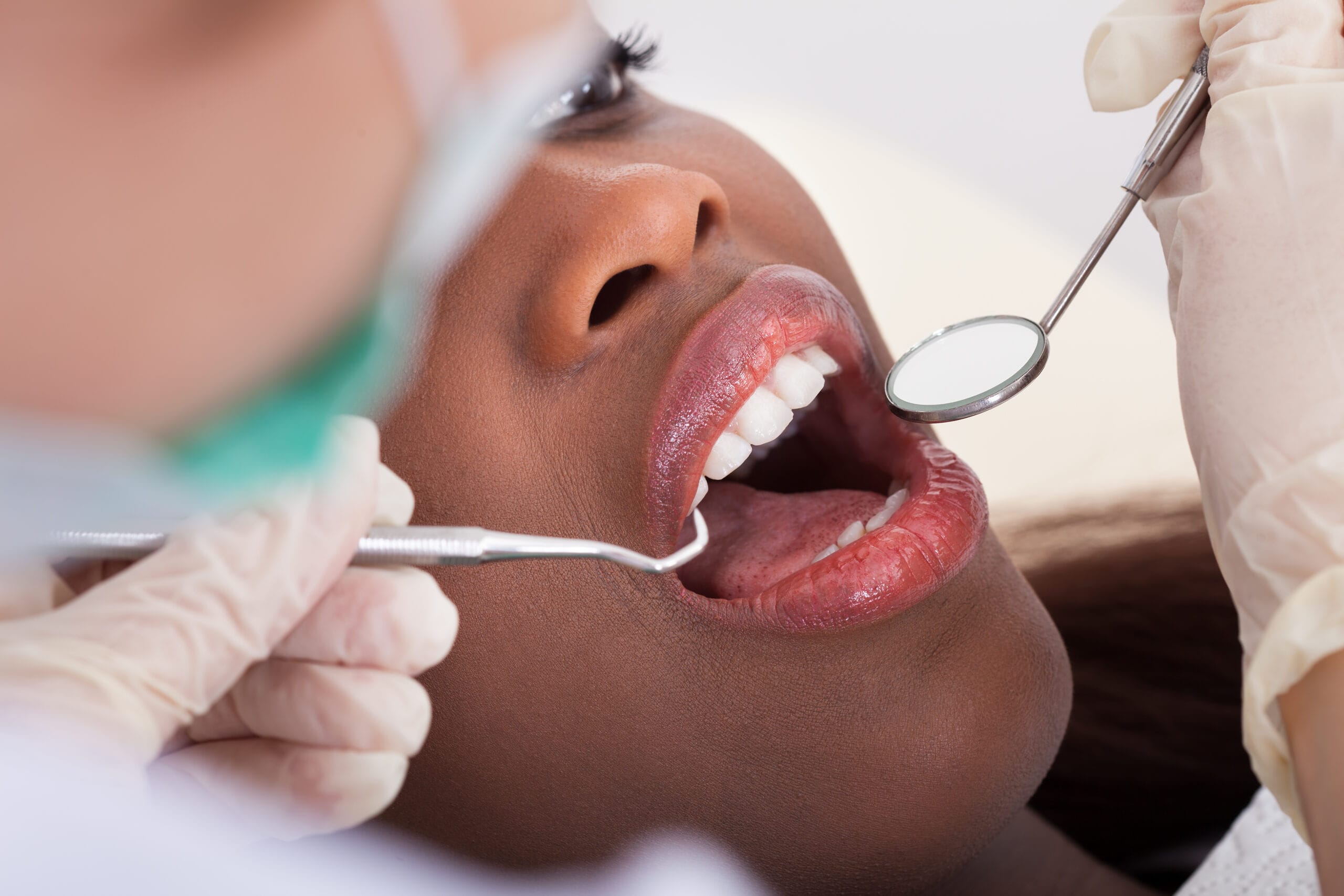 Close-up of a patient receiving a dental exam with mirror and probe instruments, highlighting assessment for root canal treatment – Root Canals