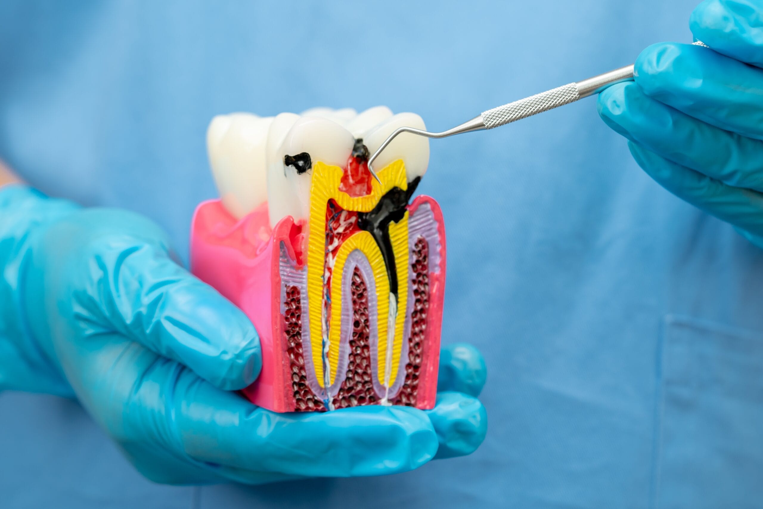 Gloved dental professional holding a cross-section model of a decayed tooth showing inflamed pulp and infection, used to explain the root canal procedure