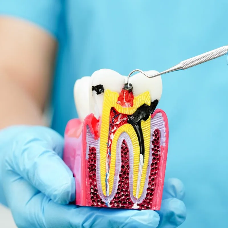 Close-up of a dental professional holding an anatomical tooth model with visible pulp infection and dental tool, illustrating the need for a root canal
