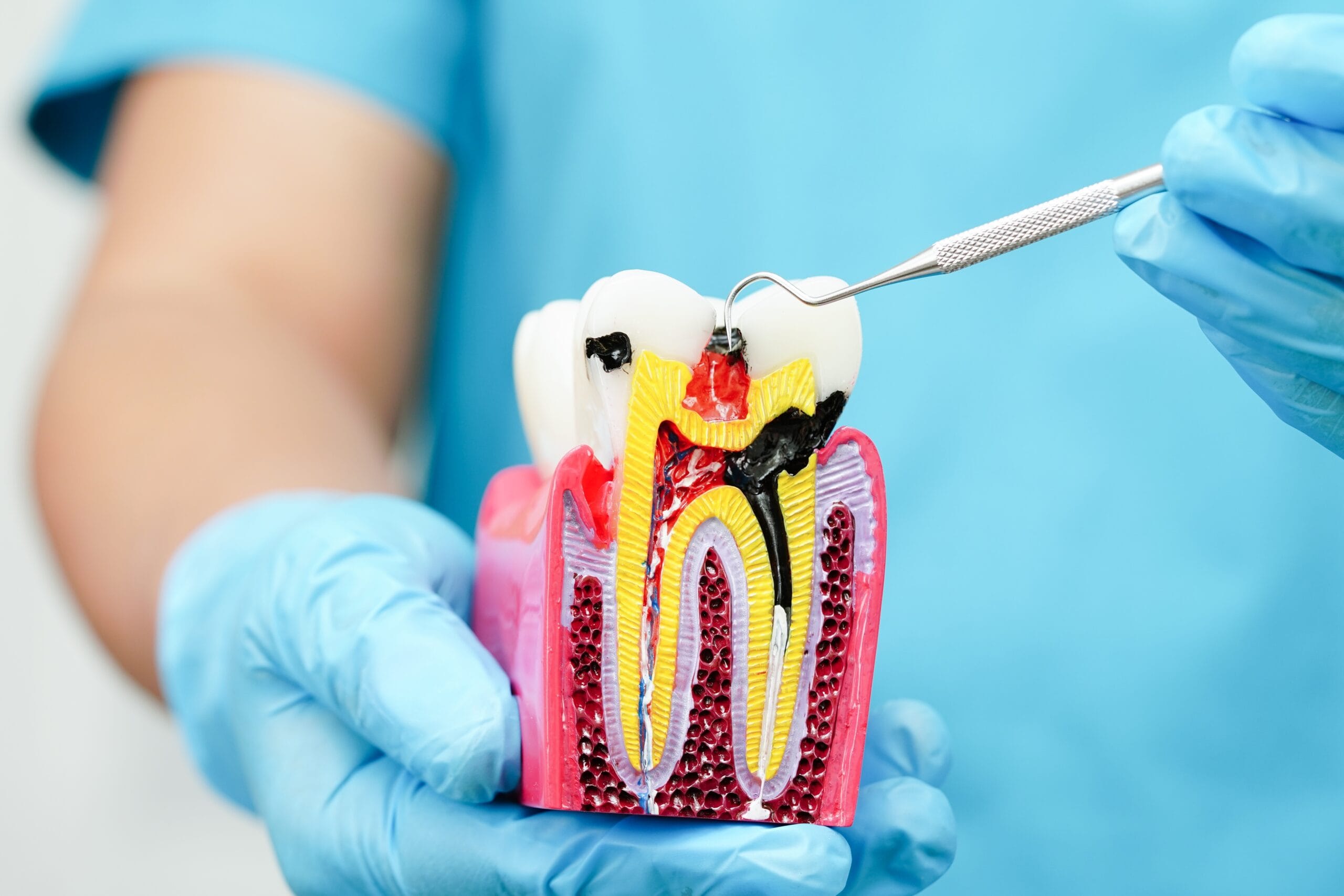 Close-up of a dental professional holding an anatomical tooth model with visible pulp infection and dental tool, illustrating the need for a root canal